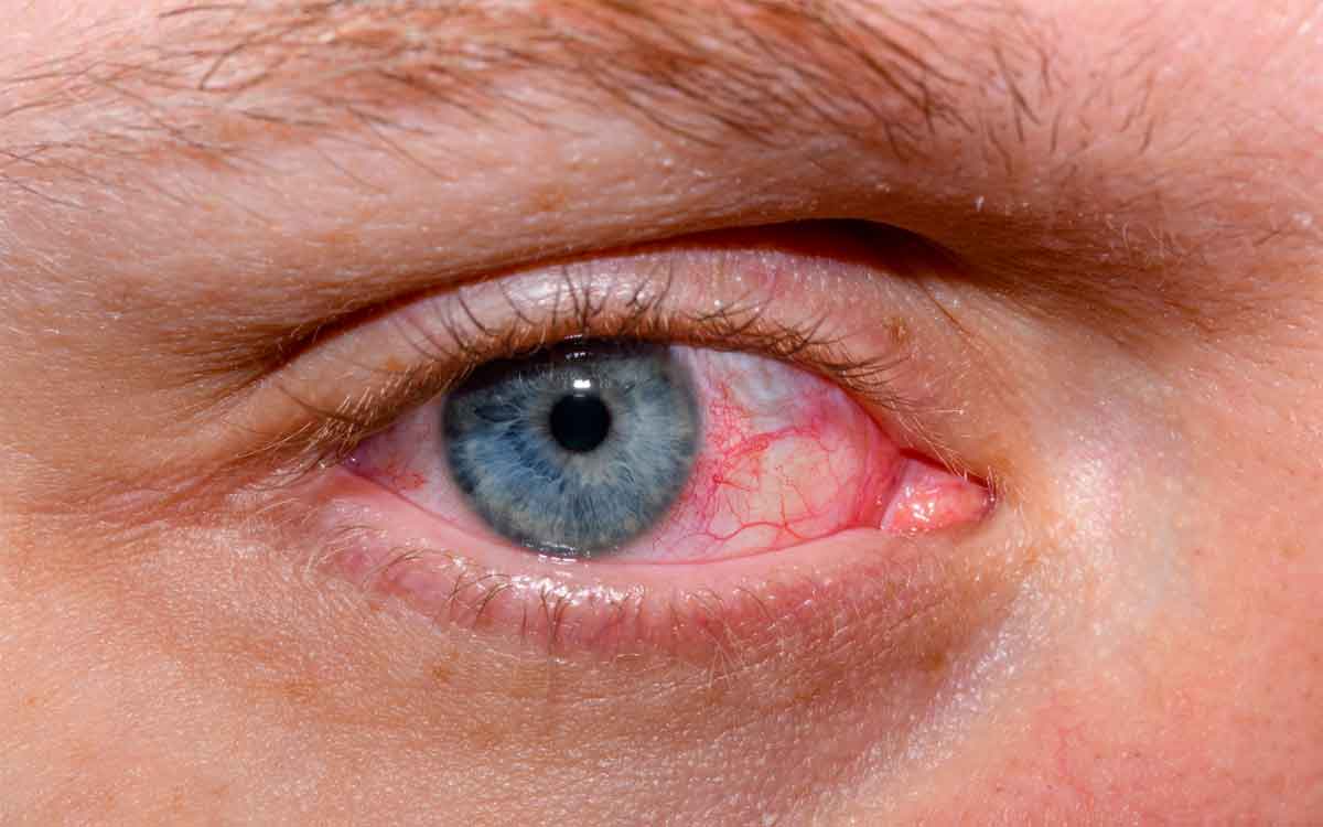 Dry Eyes | క‌ళ్లు పొడిబారి ఇబ్బందులు పెడుతూ మంట‌గా ఉంటుందా..? అయితే ఈ చిట్కాల‌ను పాటించండి..!