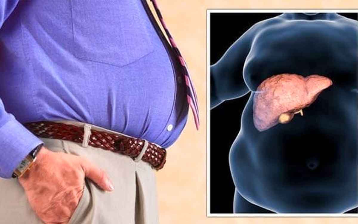 Fatty Liver Disease Symptoms | ఈ ల‌క్ష‌ణాలు క‌నిపిస్తున్నాయా.. అయితే అది ఫ్యాటీ లివర్ స‌మ‌స్య కావ‌చ్చు..!