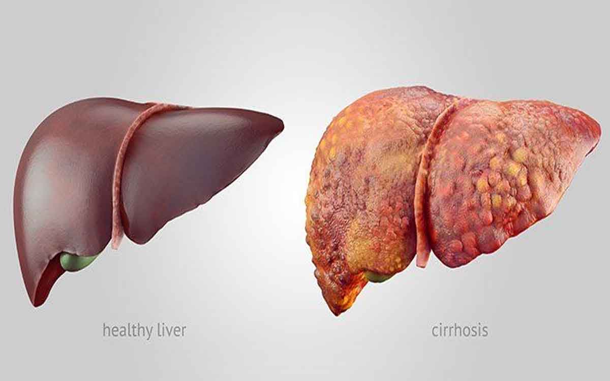 Fatty Liver Disease | చాప కింద నీరులా విస్త‌రిస్తున్న ఫ్యాటీ లివ‌ర్‌.. ఏం చేయాలి..?