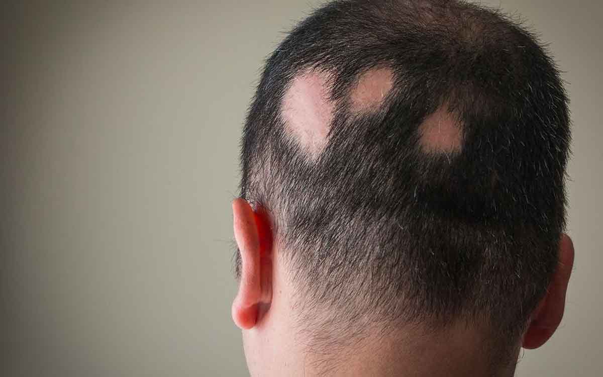 Hair Fall Home Remedies | జుట్టు బాగా రాలుతుందా.. ఈ చిట్కాల‌ను పాటిస్తే చాలు.. స‌మ‌స్య ఉండ‌దు..!