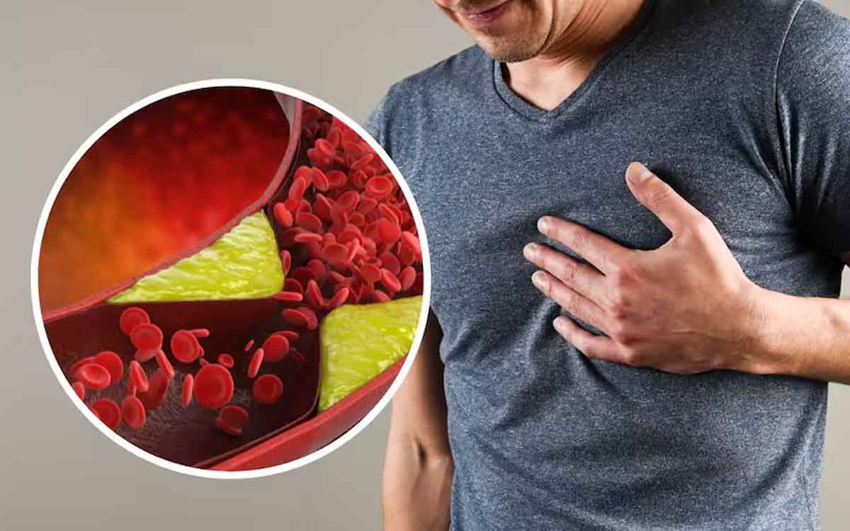 High Cholesterol Symptoms | మీలో ఈ ల‌క్ష‌ణాలు ఉన్నాయా.. అయితే మీకు కొలెస్ట్రాల్ ఎక్కువ ఉన్న‌ట్లే..!
