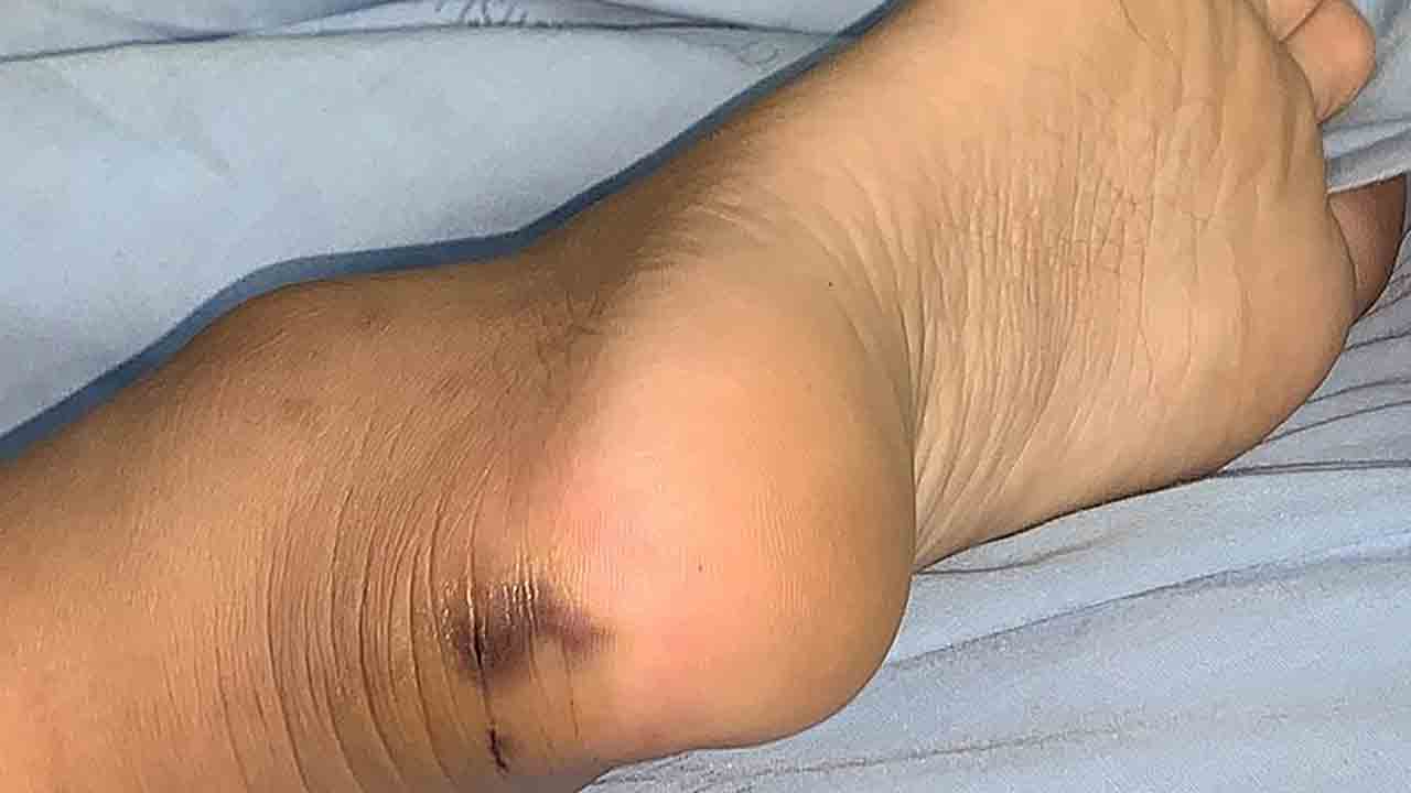 Nallagonda | గురుకుల విద్యార్థికి పాముకాటు.. ఆందోళ‌న‌లో త‌ల్లిదండ్రులు