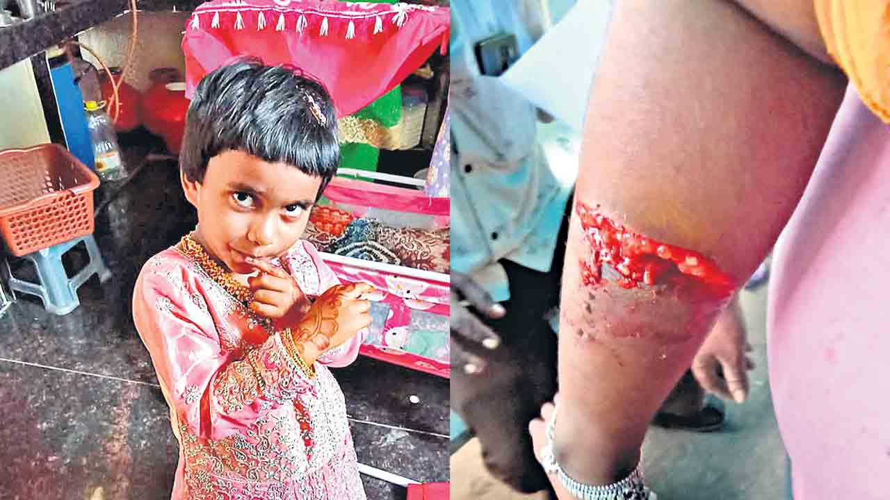 వీధి కుక్కల దాడి.. చిన్నారికి తీవ్ర గాయాలు