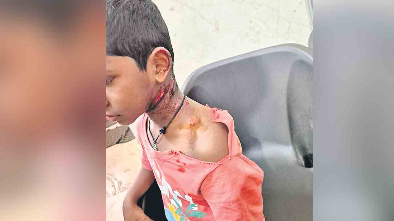 వీధి కుక్కల స్వైరవిహారం.. బాలుడికి తీవ్రగాయాలు