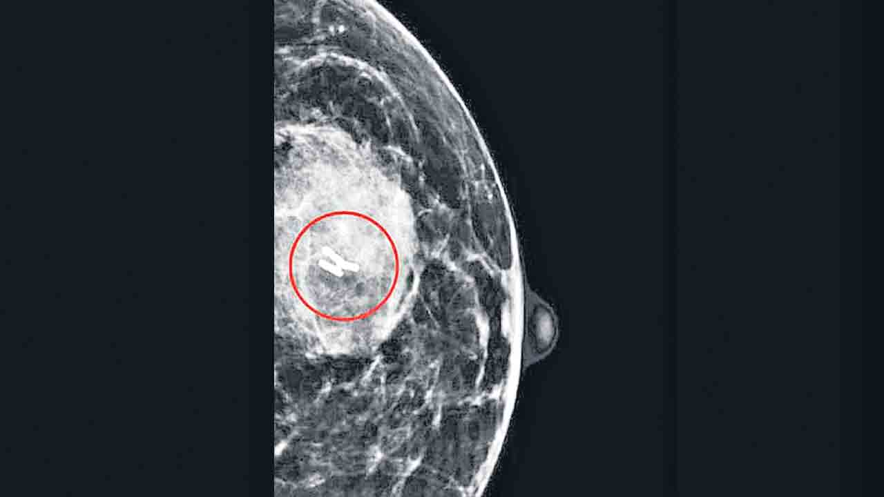 Breast Cancer | రొమ్ము క్యాన్సర్‌కు క్లిప్‌ అండ్‌ బ్లూ చికిత్స.. కొత్త పద్ధతిని అభివృద్ధి చేసిన కేరళ వైద్యులు