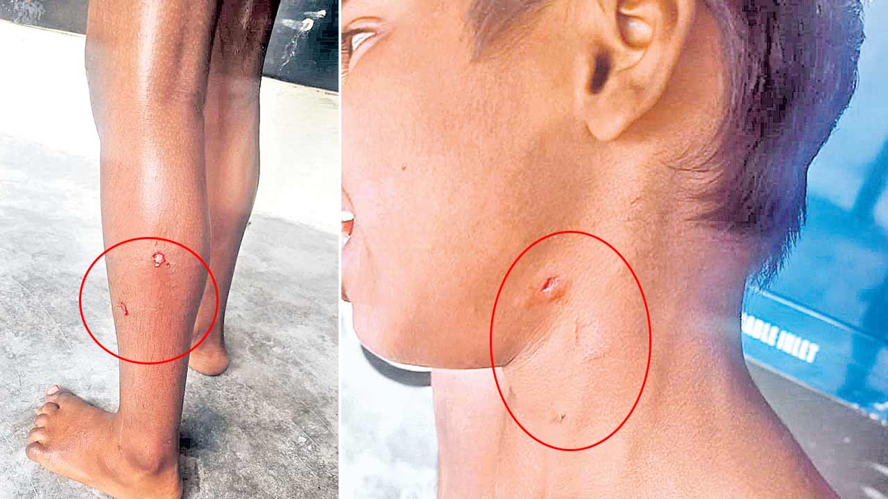 బాలుడిపై వీధికుక్క దాడి