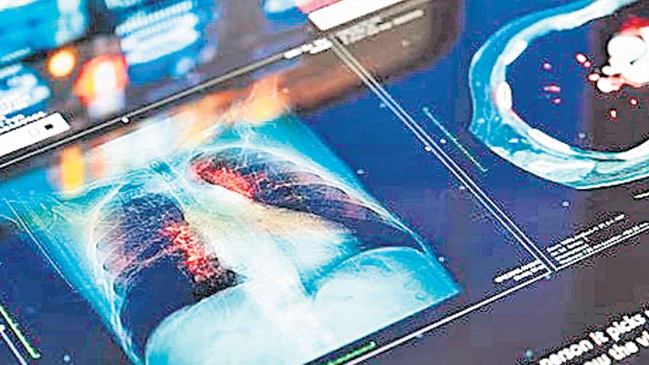 Lung Cancer | ఊపిరితిత్తుల క్యాన్సర్‌ను ముందుగానే గుర్తించే మూత్ర పరీక్ష