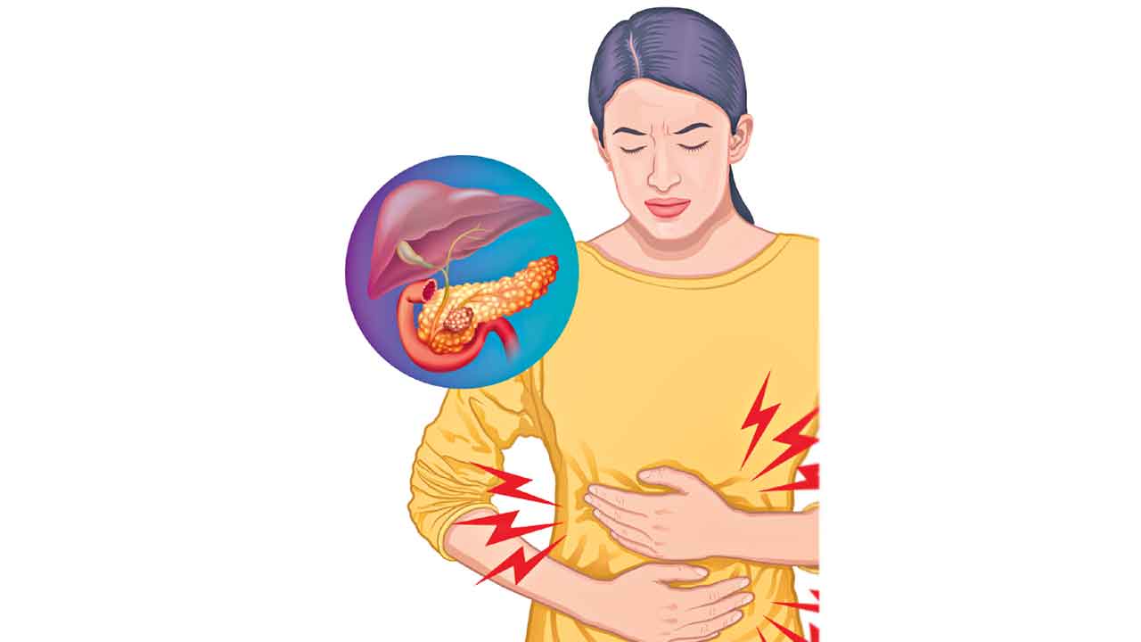 Pancreatic Cancer 3