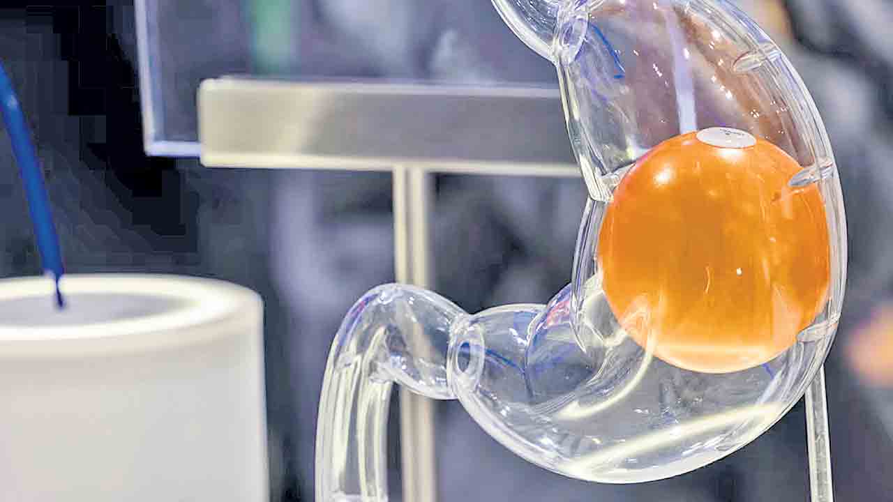Obesity | గ్యాస్ట్రిక్‌ బెలూన్‌తో ఊబకాయానికి చెక్‌..