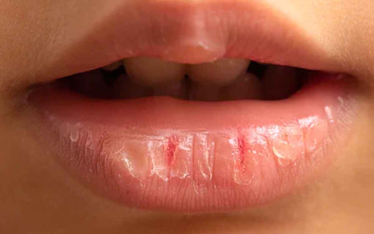 Cracked Lips | పెదవులు బాగా పగులుతున్నాయా.. అయితే ఈ చిట్కాలను పాటించండి..!