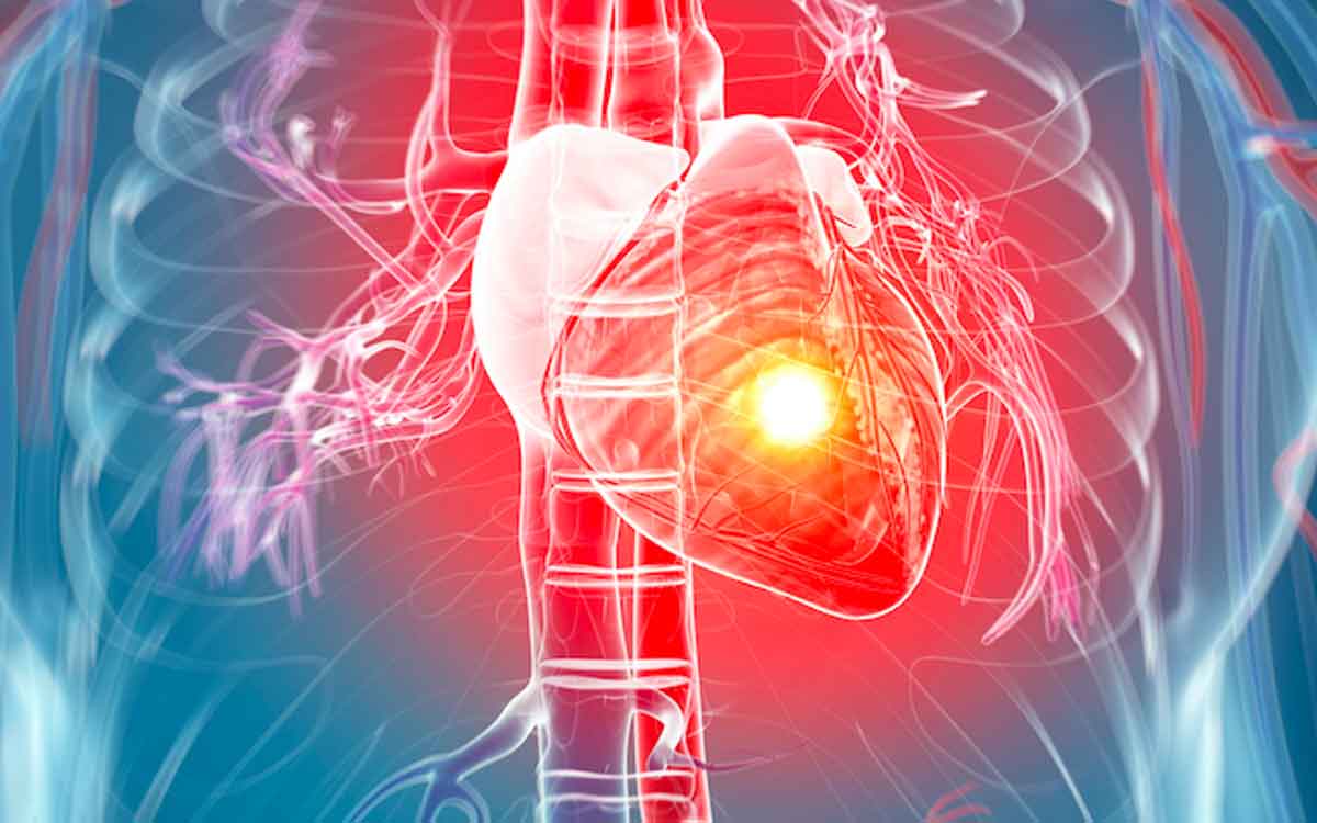 Heart Attack | జీవితంలో మీకు అస‌లు గుండె పోటు రావొద్దంటే ఇలా చేయండి..!