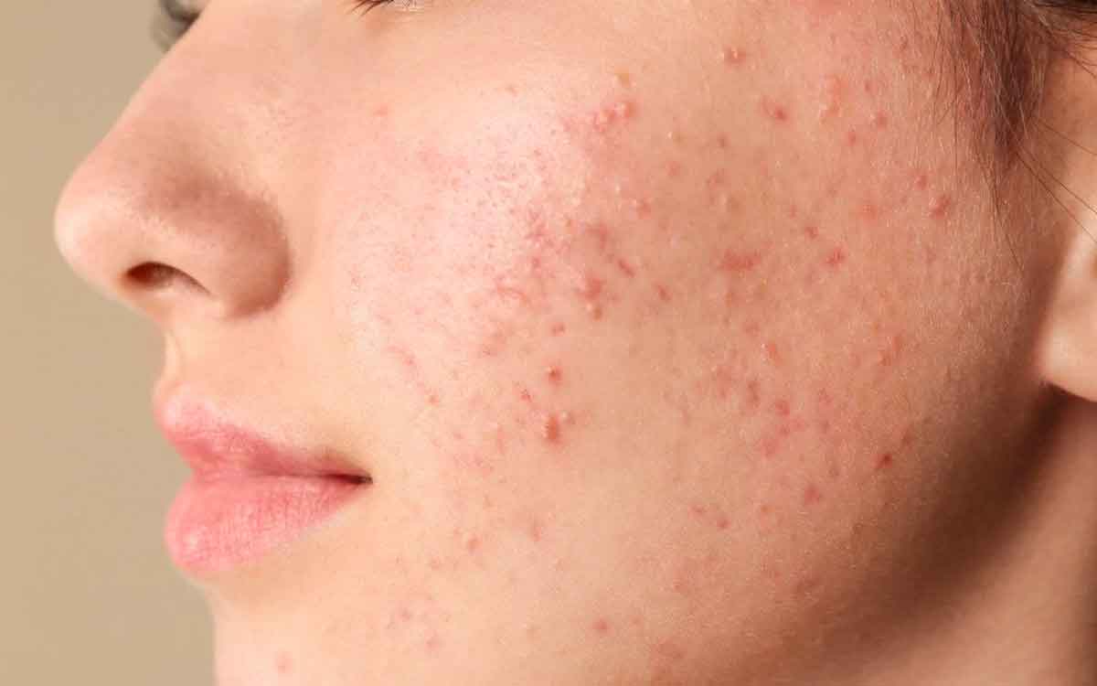 Pimples Home Remedies | ఖ‌రీదైన చికిత్స‌లు అవ‌స‌రం లేదు.. ఈ చిట్కాల‌ను పాటిస్తే మొటిమ‌లు మాయ‌మ‌వుతాయి..!