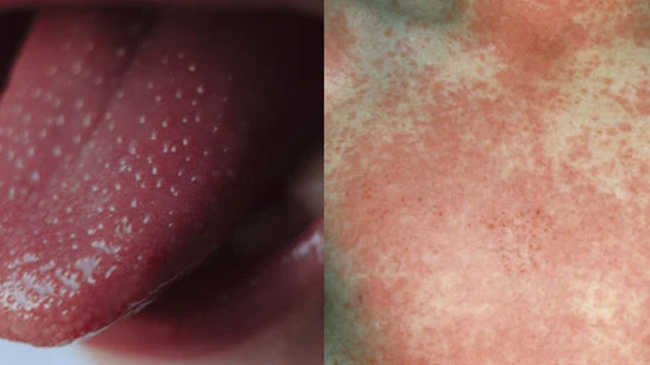 Scarlet fever | హైద‌రాబాద్‌లో పెరుగుతున్న స్కార్లెట్ ఫీవ‌ర్ కేసులు.. చిన్న పిల్ల‌లు జ‌ర జాగ్ర‌త్త‌..!
