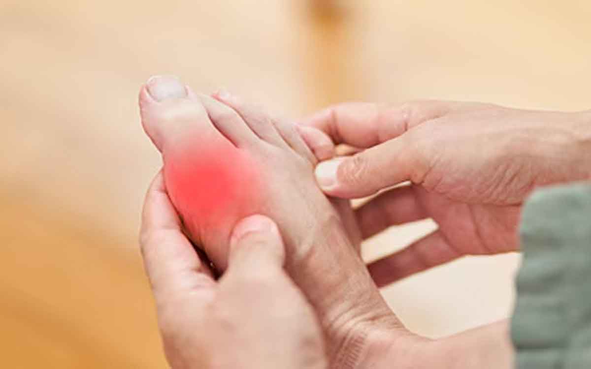 Uric Acid Levels | గౌట్ ఉందా.. యూరిక్ యాసిడ్ లెవ‌ల్స్‌ను ఇలా త‌గ్గించుకోండి..!