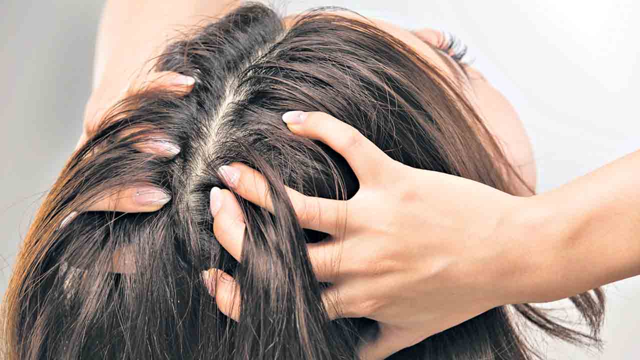 మాడు దురద ఇలా పరార్‌