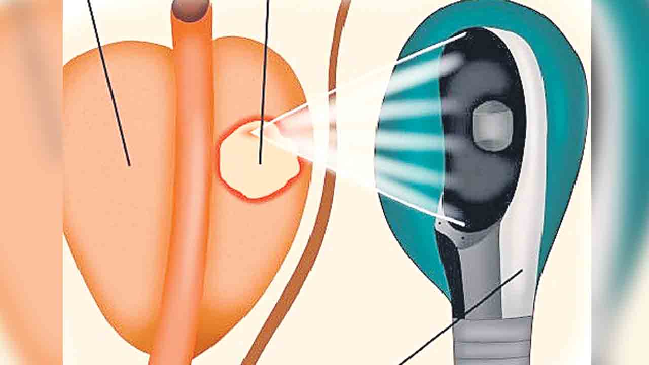 Prostate Cancer | సర్జరీ అవసరం లేదు.. అల్ట్రాసౌండ్‌తో ప్రొస్టేట్‌ క్యాన్సర్‌కు చెక్‌