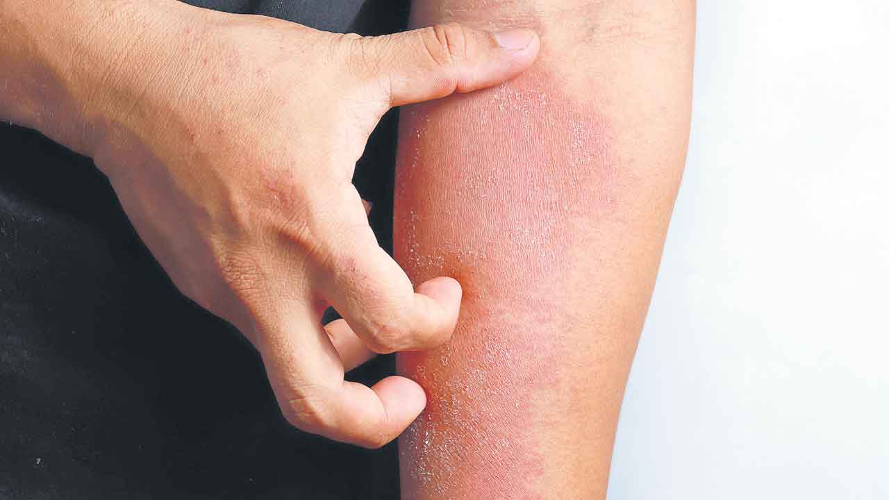 స్టెరాయిడ్‌ క్రీమ్‌ సురక్షితమేనా?