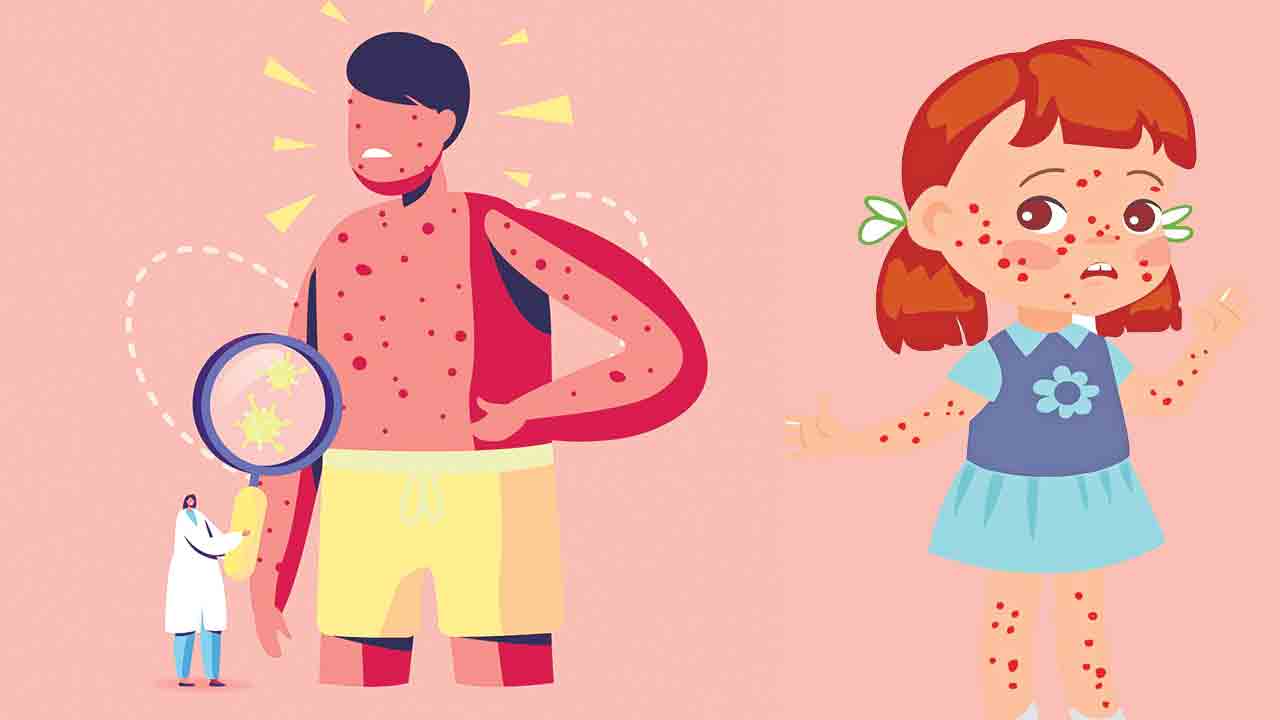 Chickenpox | చిన్నారుల పాలిట మహమ్మారి.. చికన్‌పాక్స్‌
