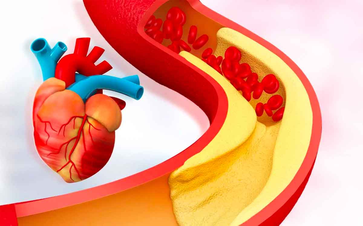 High Cholesterol Symptoms In Legs | కాళ్ల‌లో ఈ ల‌క్ష‌ణాలు క‌నిపిస్తున్నాయా..? అయితే మీ శ‌రీరంలో కొలెస్ట్రాల్ అధికంగా ఉన్న‌ట్లే..!