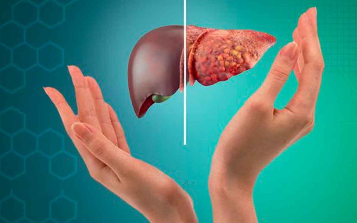Fatty Liver Causes | రోజూ మ‌నం పాటించే ఈ అల‌వాట్లు, చేసే త‌ప్పుల వ‌ల్లే ఫ్యాటీ లివ‌ర్ వ‌స్తుంద‌ని మీకు తెలుసా..?