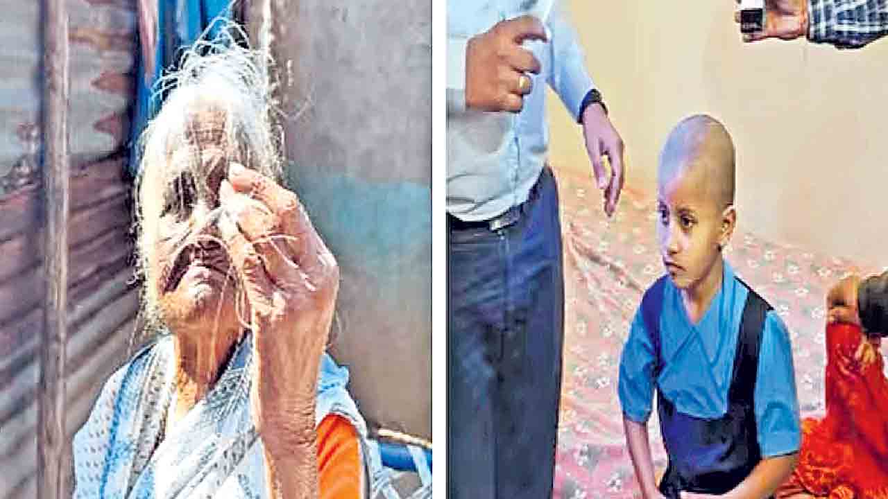 Maharashtra | రేషన్‌ గోధుమల వల్ల బట్ట తల.. మహారాష్ట్రలో వింత వ్యాధిపై నివేదిక