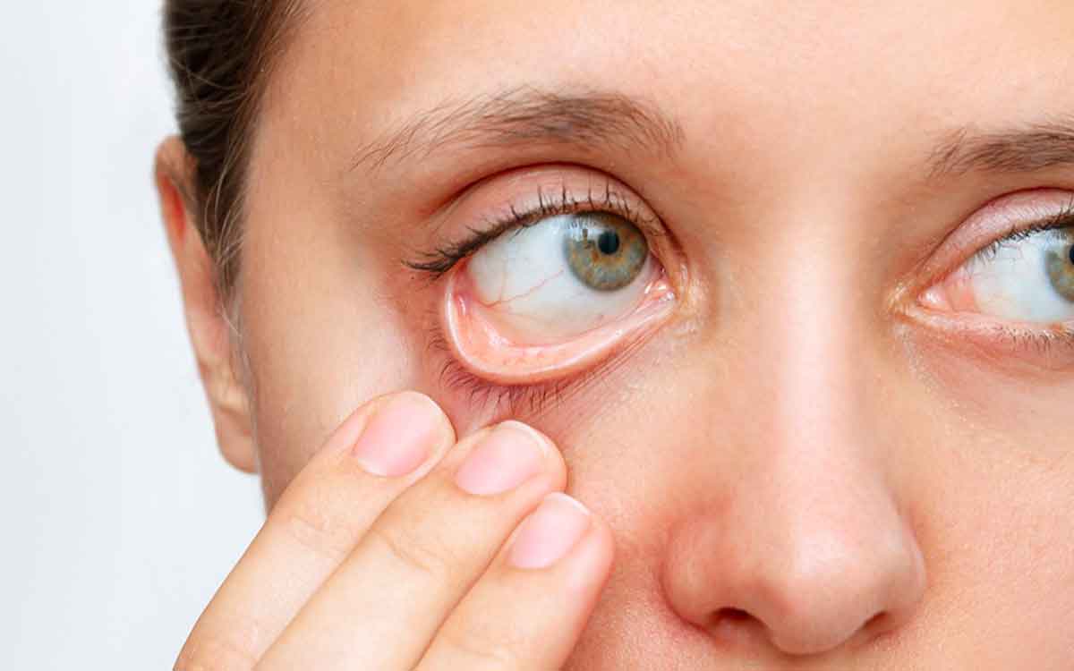 Iron Deficiency Symptoms | ఈ ల‌క్ష‌ణాలు క‌నిపిస్తున్నాయా..? అయితే ఐర‌న్ లోపం ఉన్న‌ట్లే..!