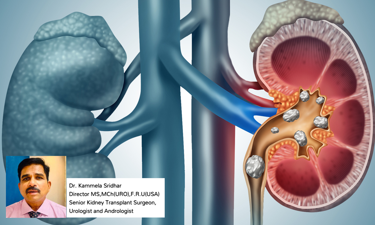 Kidney Stones | కిడ్నీ స్టోన్స్ ఎందుకు వస్తాయి..? అవి ఉంటే కనిపించే లక్షణాలు..?