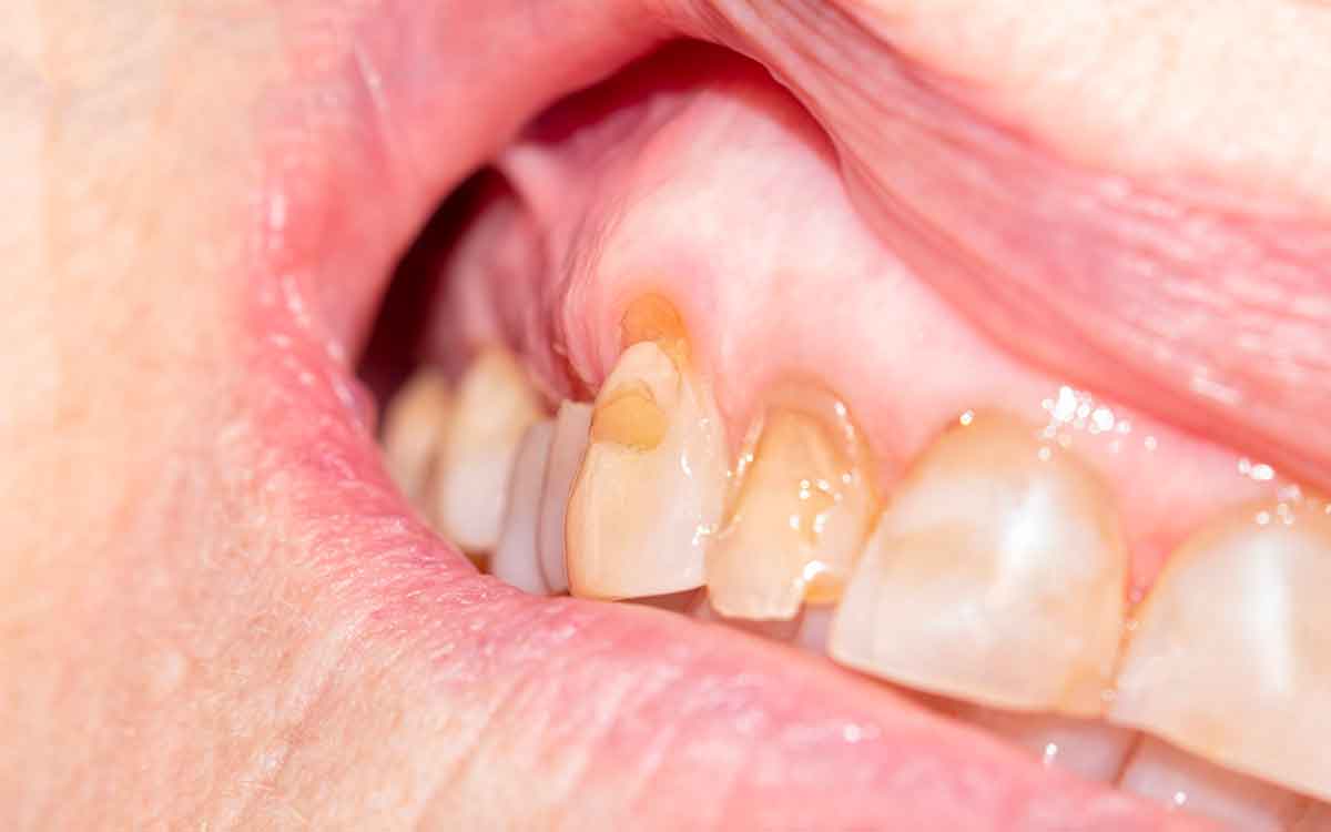 Teeth Enamel | ఈ ఆహారాల‌ను త‌ర‌చూ తింటున్నారా..? అయితే మీ దంతాలు డ్యామేజ్ అవుతాయి జాగ్ర‌త్త‌..!