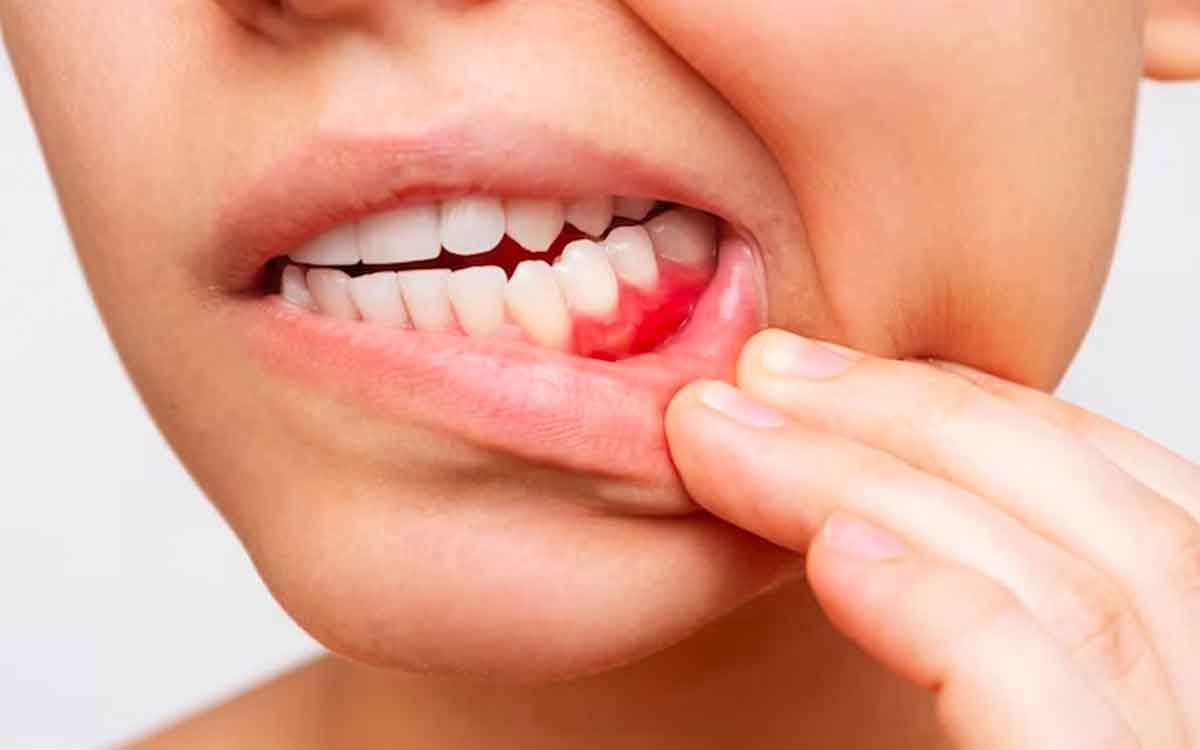 Vitamin C Deficiency Symptoms | ఈ ల‌క్ష‌ణాలు క‌నిపిస్తున్నాయా..? అయితే విట‌మిన్ సి లోపం ఉన్న‌ట్లే..!