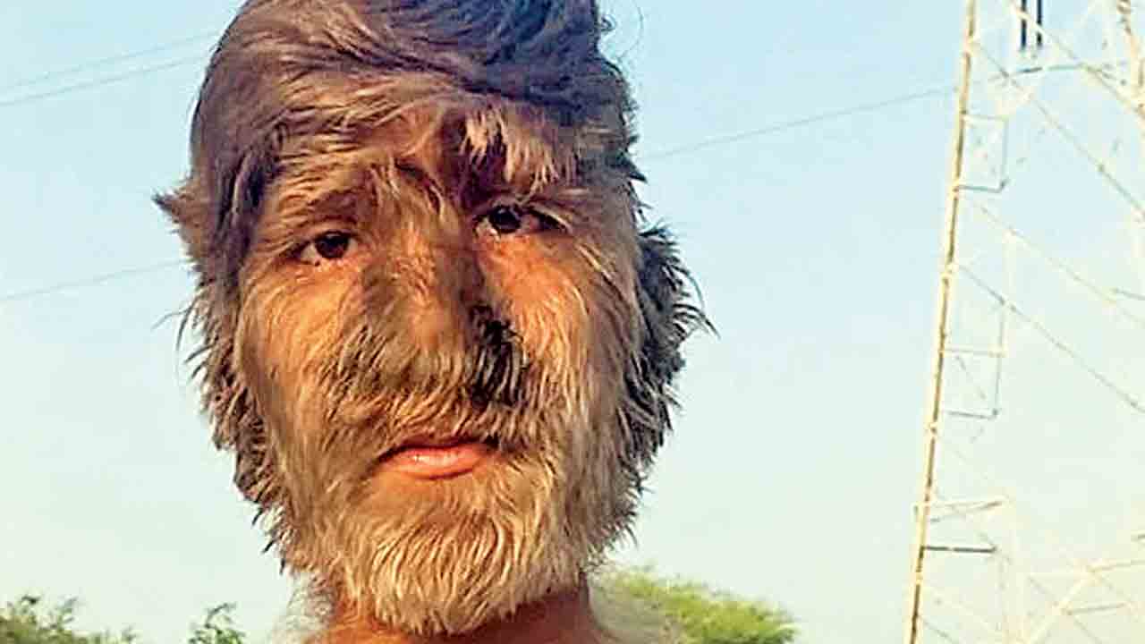 Lalit Patidar | ముఖమంతా జుట్టుతో గిన్నిస్‌ రికార్డ్‌.. ప్రతి సెంటీ మీటర్‌కు 201.72 వెంట్రుకలు