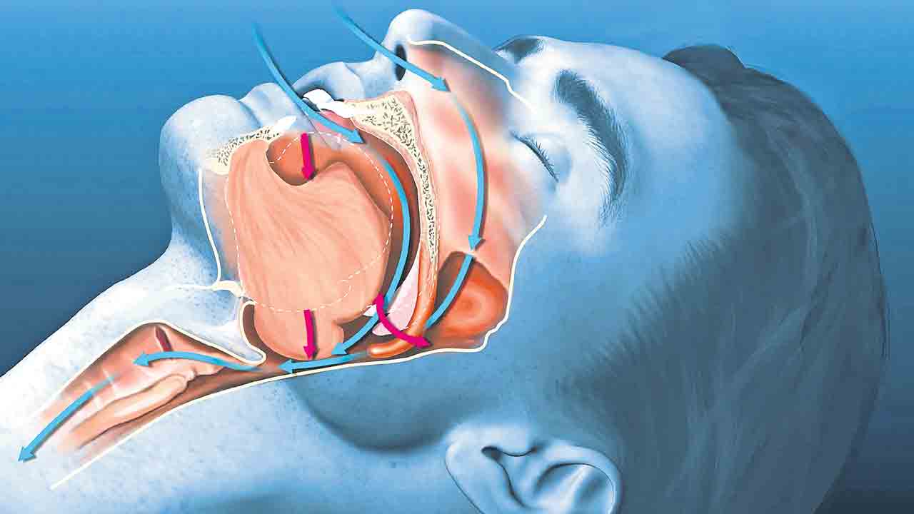 గుర్ర్ర్‌.. టెర్రర్ రోగాలకు సూచిక గురక