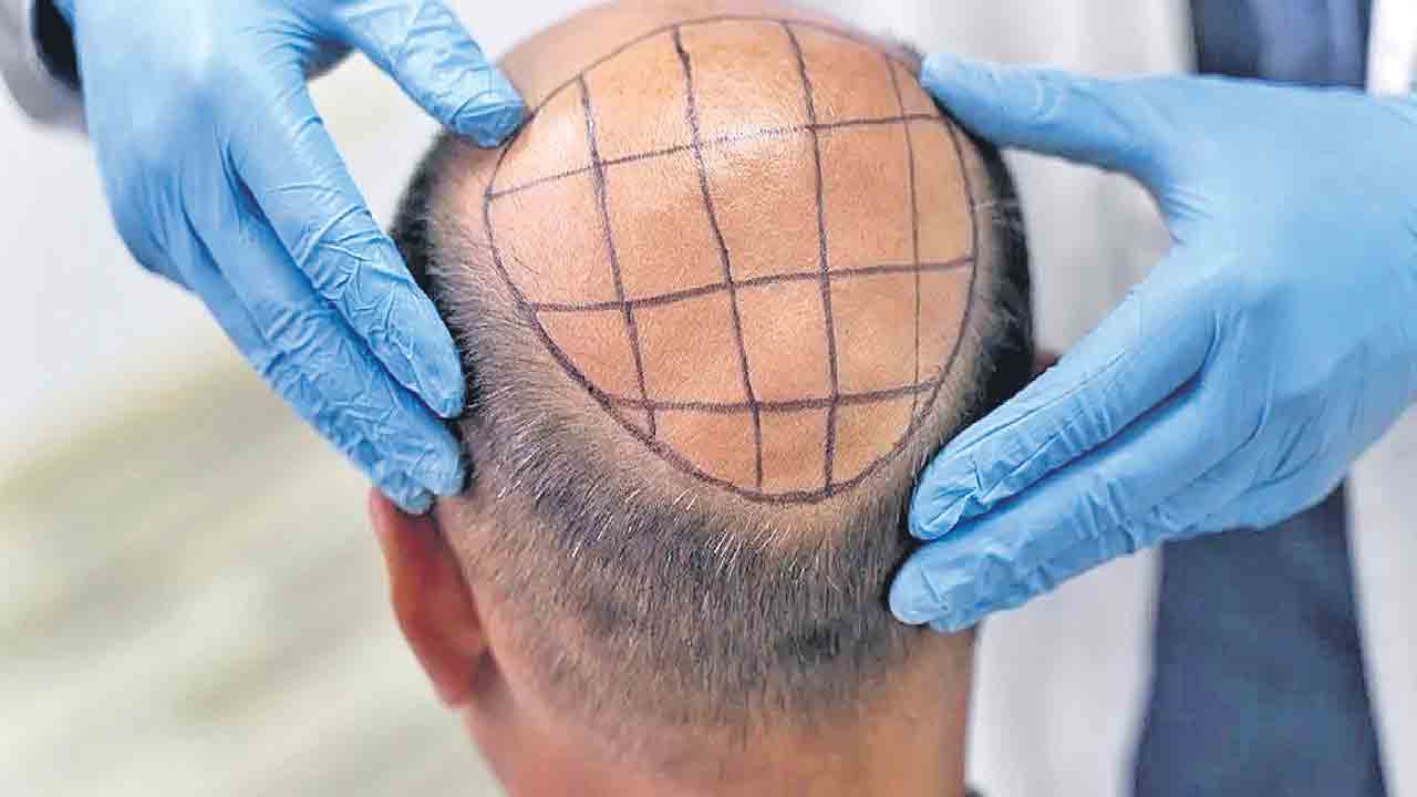 Baldness | బట్టతలతో బాధపడుతున్నారా.. అయితే ఈ గుడ్‌న్యూస్‌ మీకోసమే!