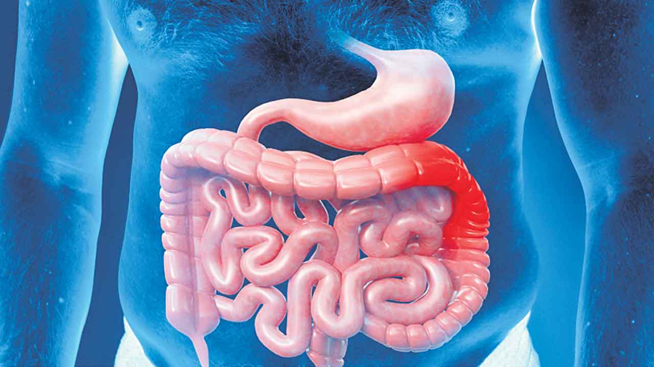 కోలన్‌ క్యాన్సర్‌ కారకాలు