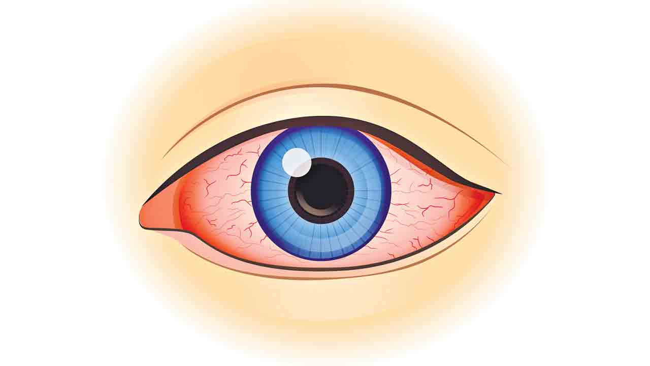 Eye Problems | 87 శాతం విద్యార్థులకు దృష్టి లోపం.. ప్రమాదపు వలయంలో చిన్నారుల కండ్లు