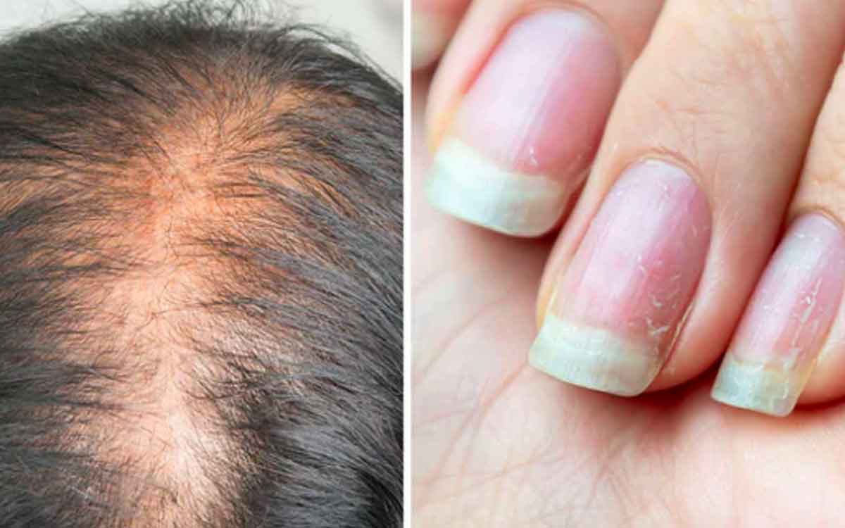 Proteins Deficiency Symptoms | ఈ ల‌క్ష‌ణాలు క‌నిపిస్తున్నాయా..? అయితే ప్రోటీన్ల లోపం ఉందేమో చెక్ చేసుకోండి..!