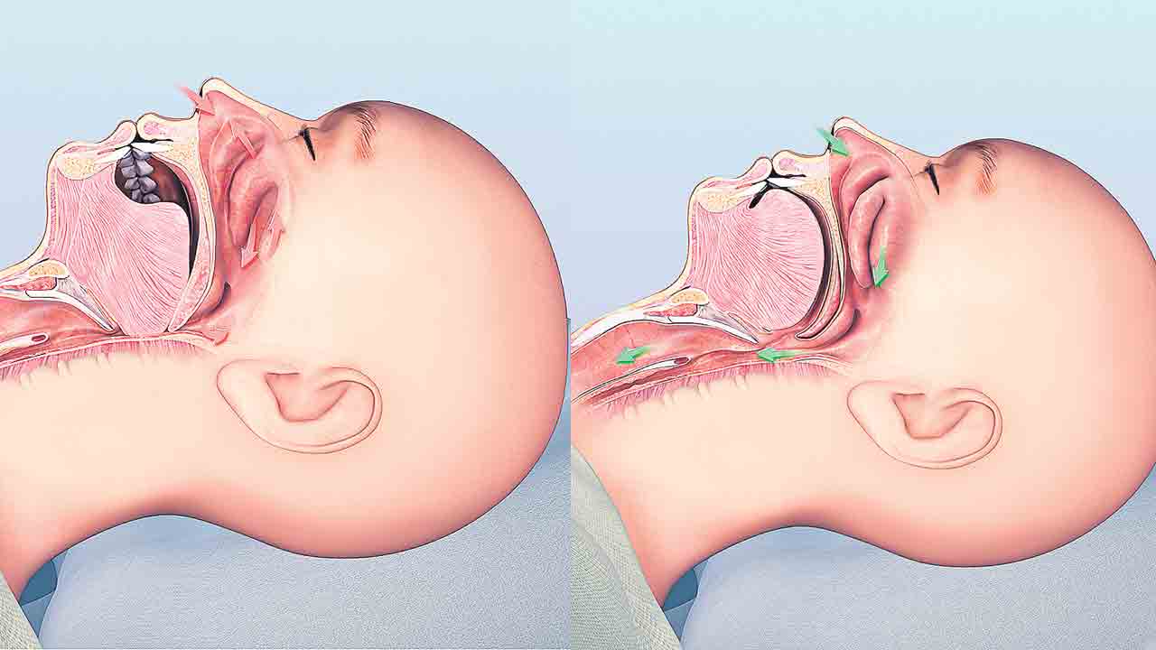 Snoring Problems