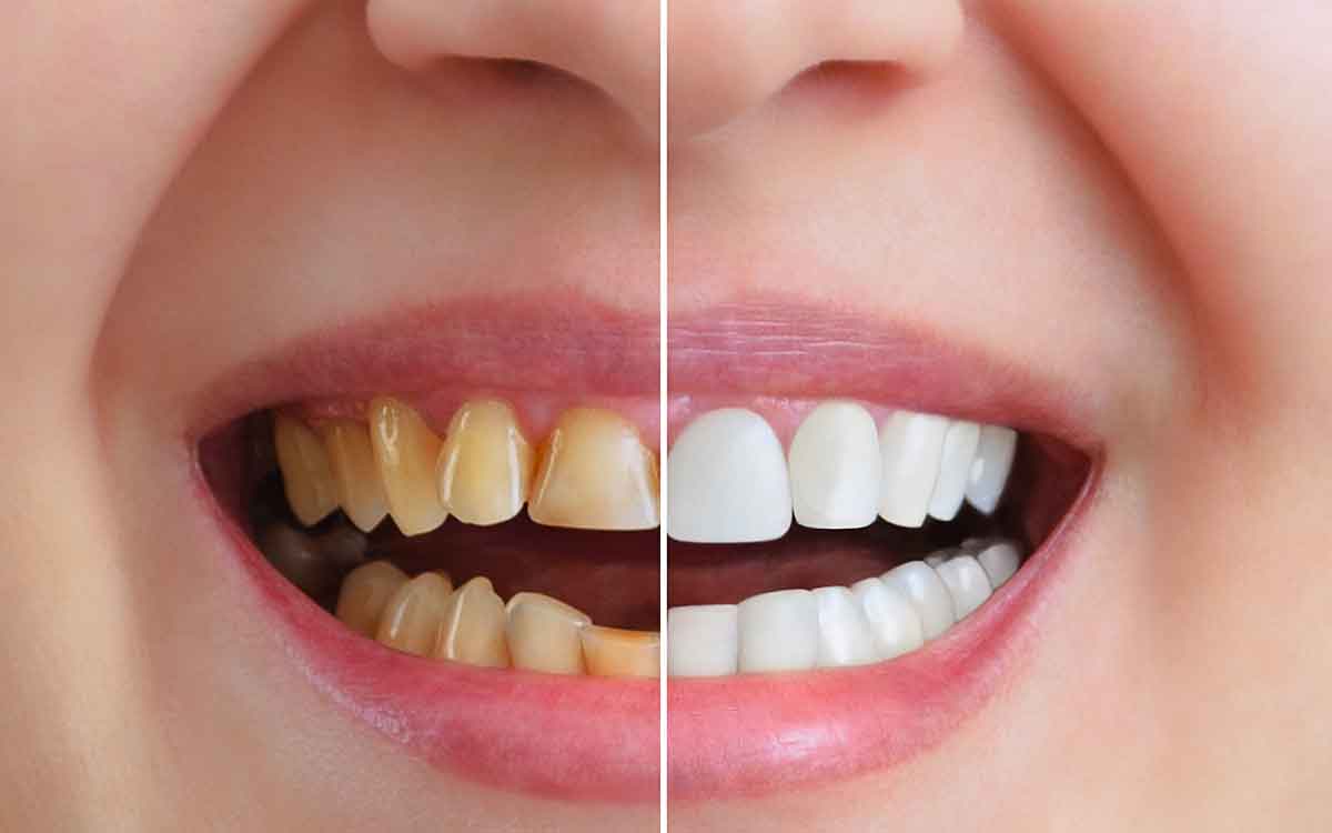 Teeth Whitening | ఈ చిట్కాల‌ను పాటిస్తే.. ఎంత‌టి గార ప‌ట్టిన దంతాలు అయినా తెల్ల‌గా మారాల్సిందే..!