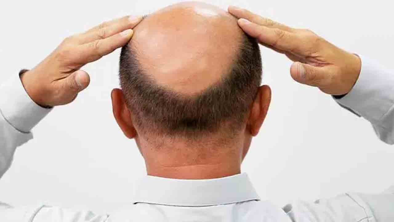 బట్టతలపై జుట్టు మొలిపిస్తామంటూ..