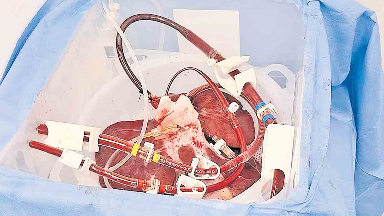 పంది కాలేయంతో డయాలసిస్‌