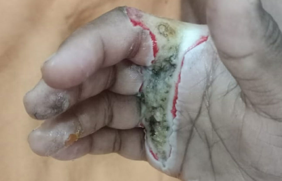 Eelectric wire | విద్యుత్ వైరు తగిలి బాలుడికి తీవ్ర గాయాలు