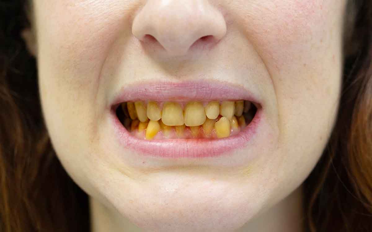 Whitening Teeth | మీ దంతాల‌పై ఉండే పాచి, గార‌, ప‌సుపుద‌నం పోవాలంటే.. ఈ స‌హ‌జ‌సిద్ధ‌మైన చిట్కాల‌ను పాటించండి..