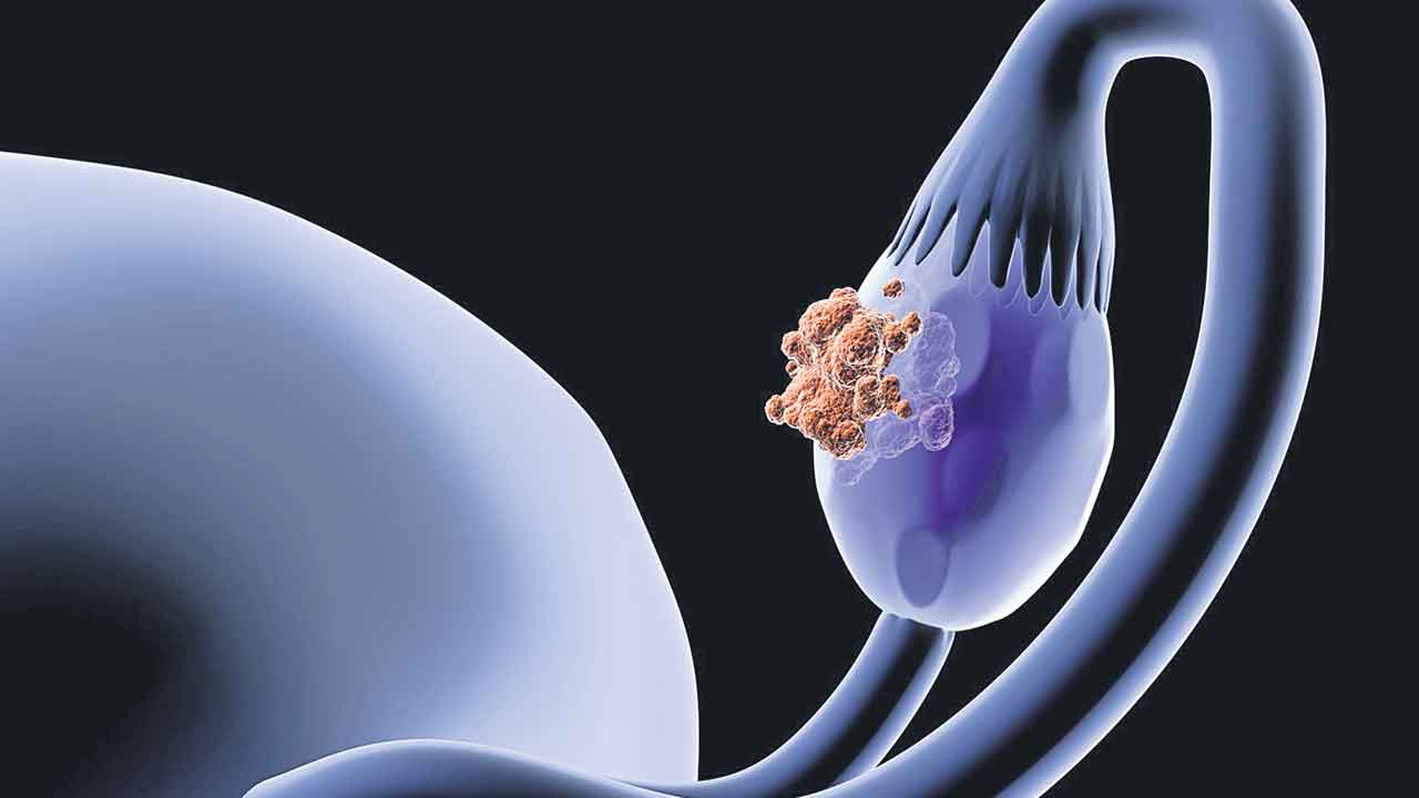 Ovarian Cance 1