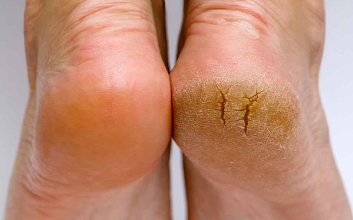 Cracked Heels | పాదాల ప‌గుళ్లు ఈ సీజ‌న్‌లోనూ ఇబ్బంది పెడుతున్నాయా.. అయితే ఇలా చేయండి..