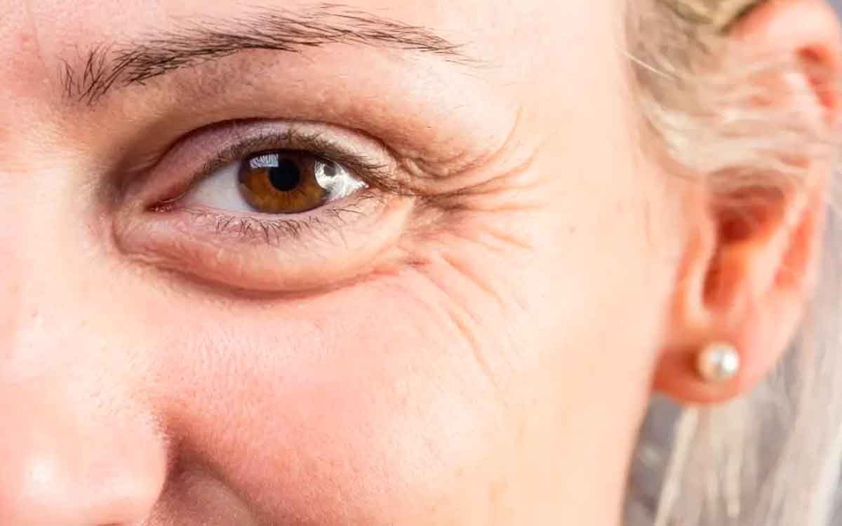 Skin Wrinkles | ముఖంపై వృద్ధాప్య ఛాయలు పెరిగిపోయాయా..? ఈ చిట్కాలను పాటిస్తే ముడతలు తగ్గుతాయి..!