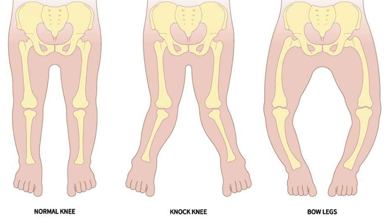 వంకరకాళ్లు ప్రమాదకరమా?