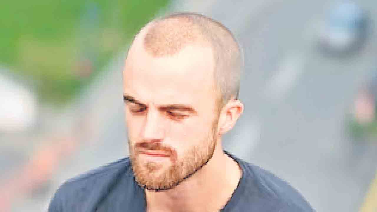 బట్టతల నివారణకు సరికొత్త చికిత్స!