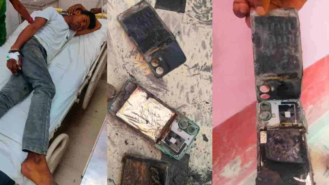 Mobile Explodes | చికిత్స పొందుతున్న రోగి.. పేలిన జేబులోని మొబైల్‌ ఫోన్‌