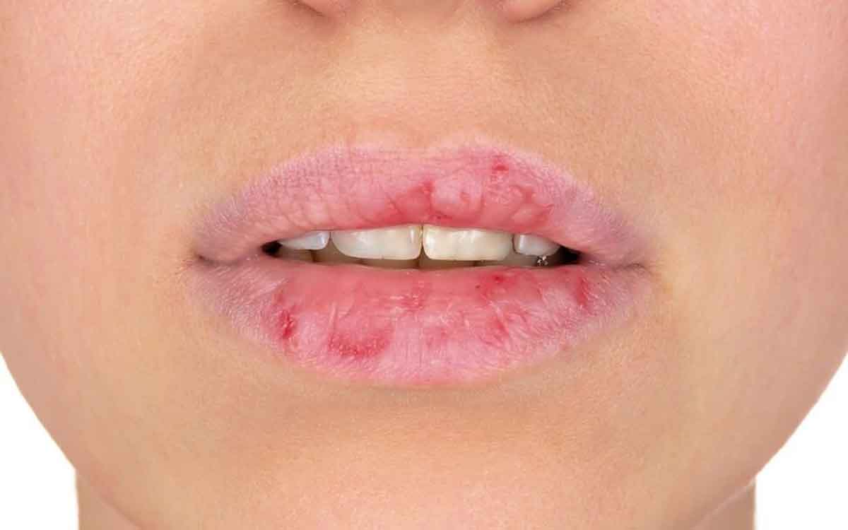 Cracked Lips | పెద‌వులు బాగా ప‌గిలి ఇబ్బంది పెడుతున్నాయా.. ఈ స‌హ‌జ‌సిద్ధ‌మైన చిట్కాల‌ను పాటించండి..