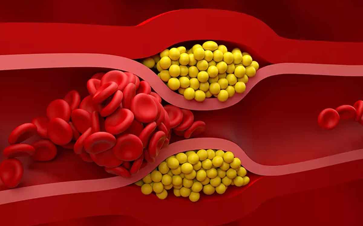 High Cholesterol Diet | మీ శ‌రీరంలో కొలెస్ట్రాల్ మ‌రీ అధికంగా ఉందా.. అయితే ఈ ఆహారాల‌ను తినాల్సిందే..!