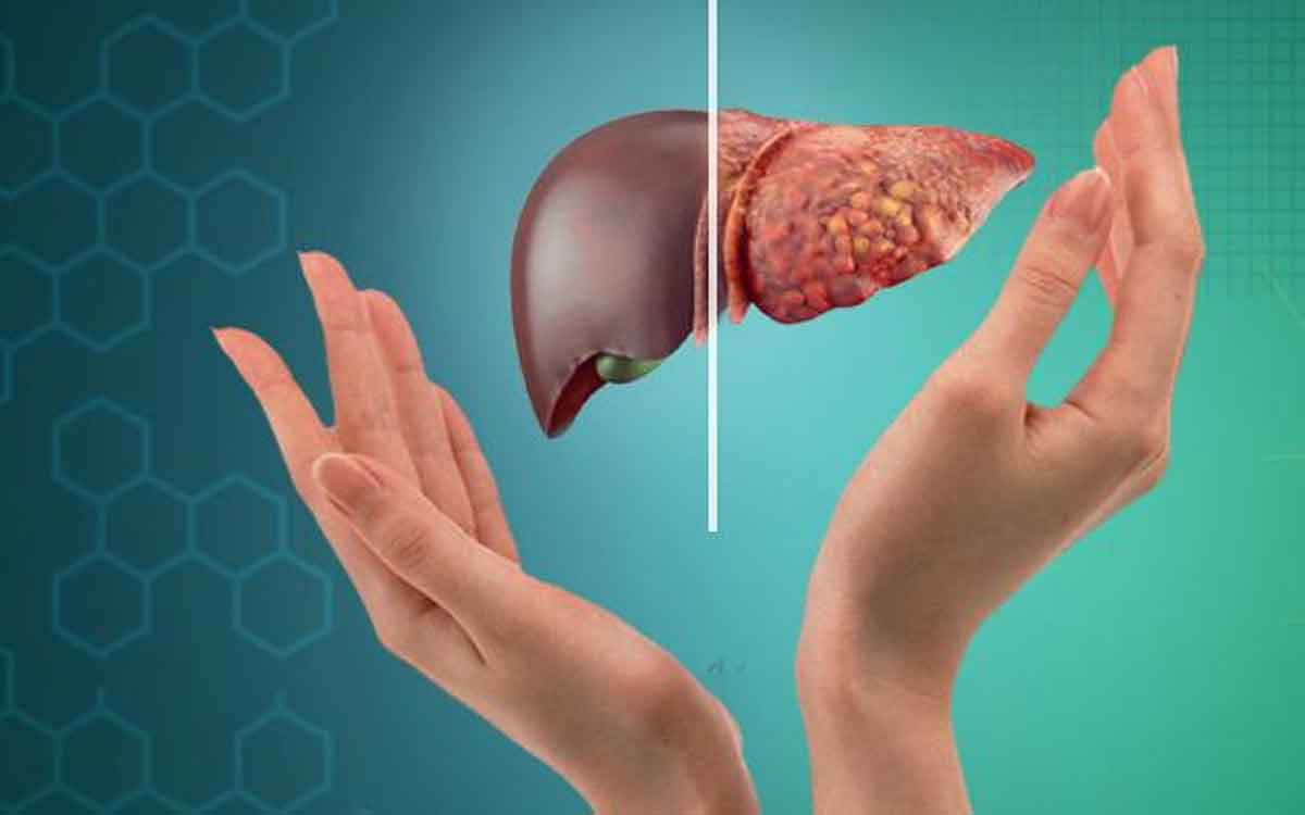 Diet For Fatty Liver Disease | లివ‌ర్‌లో ఉన్న కొవ్వు క‌రిగి క్లీన్ అయ్యేందుకు ఈ ఆహారాల‌ను తినాలి..!